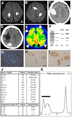 Recurrent Lobar Hemorrhages and Multiple Cortical Superficial Siderosis in a Patient of Alzheimer's Disease With Homozygous APOE ε2 Allele Presenting Hypobetalipoproteinemia and Pathological Findings of 18F-THK5351 Positron Emission Tomography: A Case Report